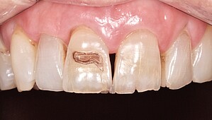 Row of teeth before treatment